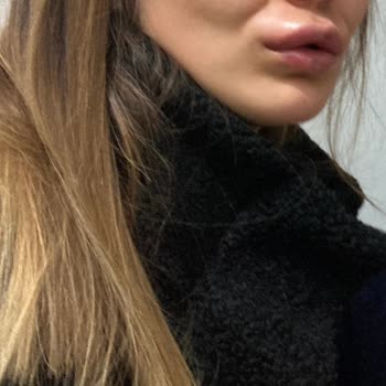 Op. Dr. Hasan Fındık Yanlış Dolgu, Şişmiş Dudak Ve Faturasız Ödeme Şikayeti