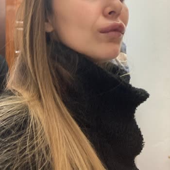 Op. Dr. Hasan Fındık Yanlış Dolgu, Şişmiş Dudak Ve Faturasız Ödeme Şikayeti