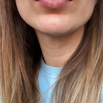 Op. Dr. Hasan Fındık Yanlış Dolgu, Şişmiş Dudak Ve Faturasız Ödeme Şikayeti