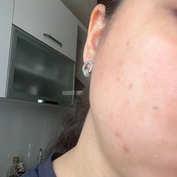 Sebos Serumu Cilt Reaksiyonu Ve İade Reddi