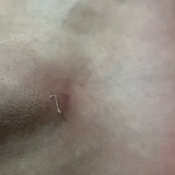 Ayakkabının Cilt Tahrişi Ve Mağaza Reddi Üzerine İade Talebi