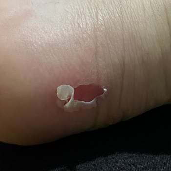 Ayakkabının Cilt Tahrişi Ve Mağaza Reddi Üzerine İade Talebi