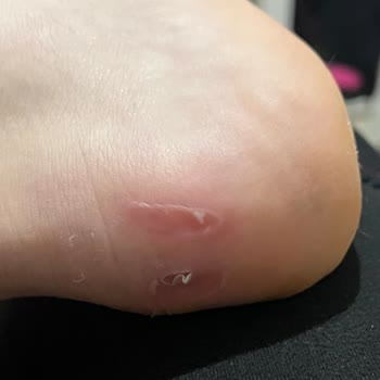 Ayakkabının Cilt Tahrişi Ve Mağaza Reddi Üzerine İade Talebi