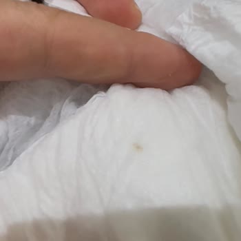 Sleepy Bebek Bezinde Yabancı Cisim Bulunması Bebek Sağlığını Tehdit Ediyor