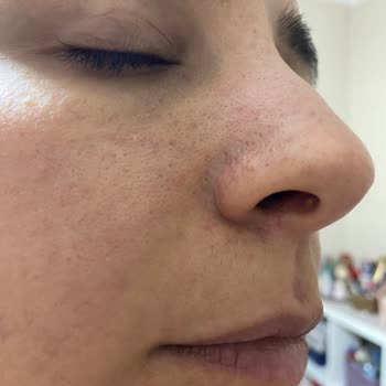 La Roche Posay Ürünleri Cilt Sorunları Yaratıyor, İade Ve Telafi Talebi