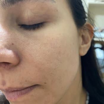 La Roche Posay Ürünleri Cilt Sorunları Yaratıyor, İade Ve Telafi Talebi