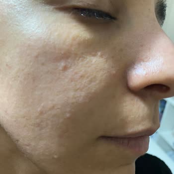 La Roche Posay Ürünleri Cilt Sorunları Yaratıyor, İade Ve Telafi Talebi