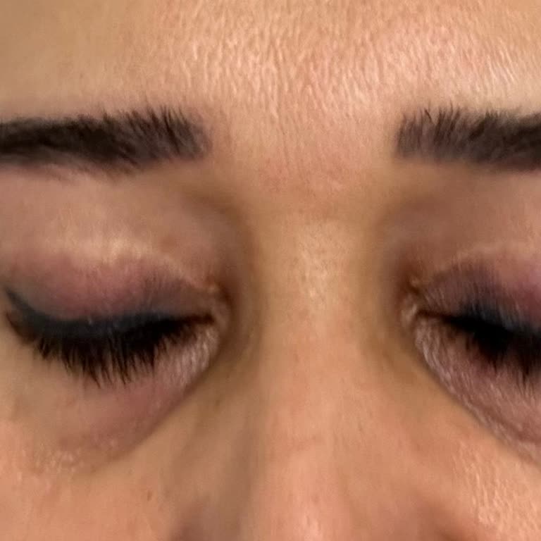 Göz Kapaklarındaki Asimetri Ve İzlerden Dolayı Ücret İadesi Talebi