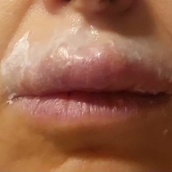 Lykd Likit Rujda Şiddetli Alerjik Reaksiyon Ve Gratis Mağazalarından Çekilmesi İsteği