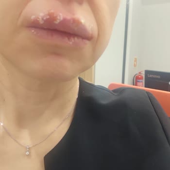 Lykd Likit Rujda Şiddetli Alerjik Reaksiyon Ve Gratis Mağazalarından Çekilmesi İsteği