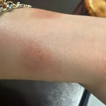 Apple Watch Alerjik Reaksiyonundan Dolayı Teknosa’dan İade Ve Sağlık Masrafları Talebi