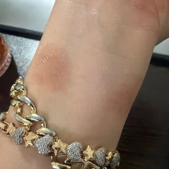 Apple Watch Alerjik Reaksiyonundan Dolayı Teknosa’dan İade Ve Sağlık Masrafları Talebi