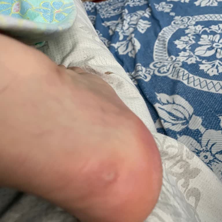 Asics Gel Nimbus 10.1 GTX Ayakkabısının Kısa Sürede Topuk Yırtılması Ve Üretim Hatası İddiası