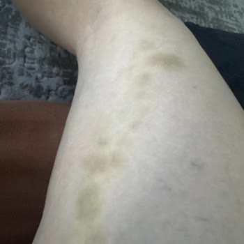 Mozze Mosmor Bacaklara Neden Olan Selülit Aleti ve Şirketin Yanıtsızlığı