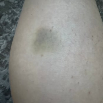 Mozze Mosmor Bacaklara Neden Olan Selülit Aleti ve Şirketin Yanıtsızlığı