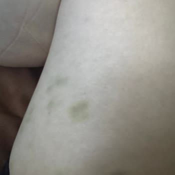 Mozze Mosmor Bacaklara Neden Olan Selülit Aleti ve Şirketin Yanıtsızlığı