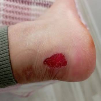 Harley Davidson Botunda Ayak Ağrısı Ve Yara: Değişim Veya İade Talebi