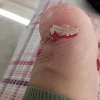 Harley Davidson Botunda Ayak Ağrısı Ve Yara: Değişim Veya İade Talebi