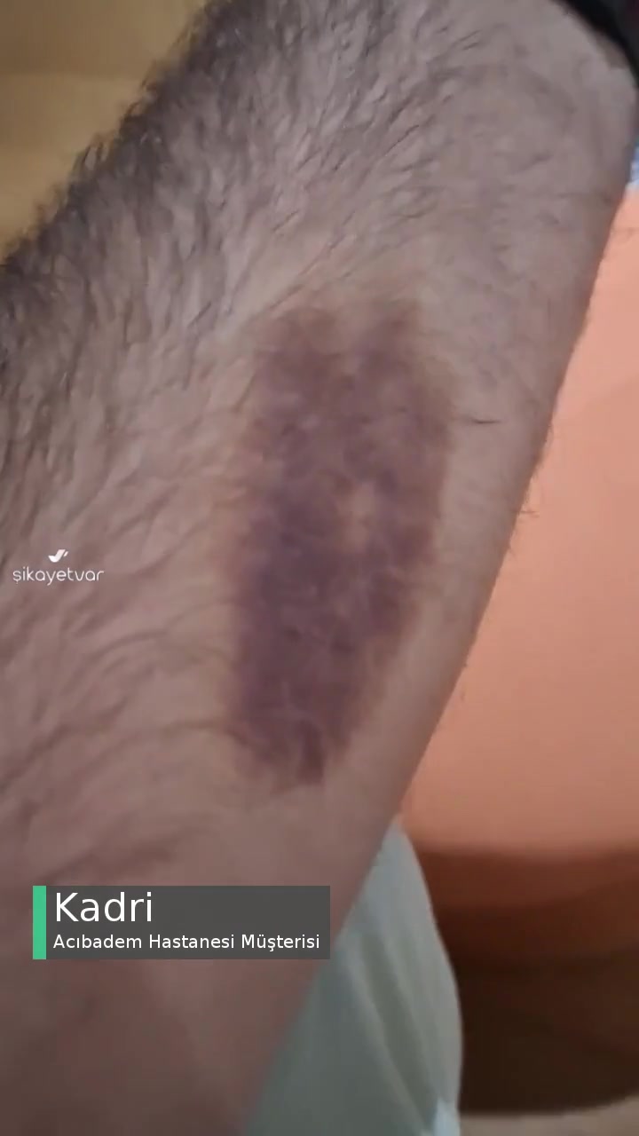 Acıbadem Acildeki Tedavi Sonrası Kolumdaki Morluk 2 Haftadır Geçmedi videonun kapak resmi