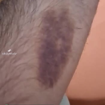 Acıbadem Acildeki Tedavi Sonrası Kolumdaki Morluk 2 Haftadır Geçmedi
