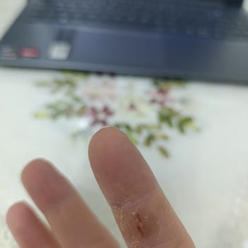 Pril Losyon Deterjanı Ciltte Şiddetli Yanma Ve Kanamalara Sebep Oldu