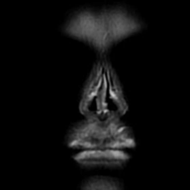 Kapanan Hastane Ve Kayıt Sorunu Burun Ameliyatı Sonrası Nefes Darlığı Ve Estetik Zarara Şikayet