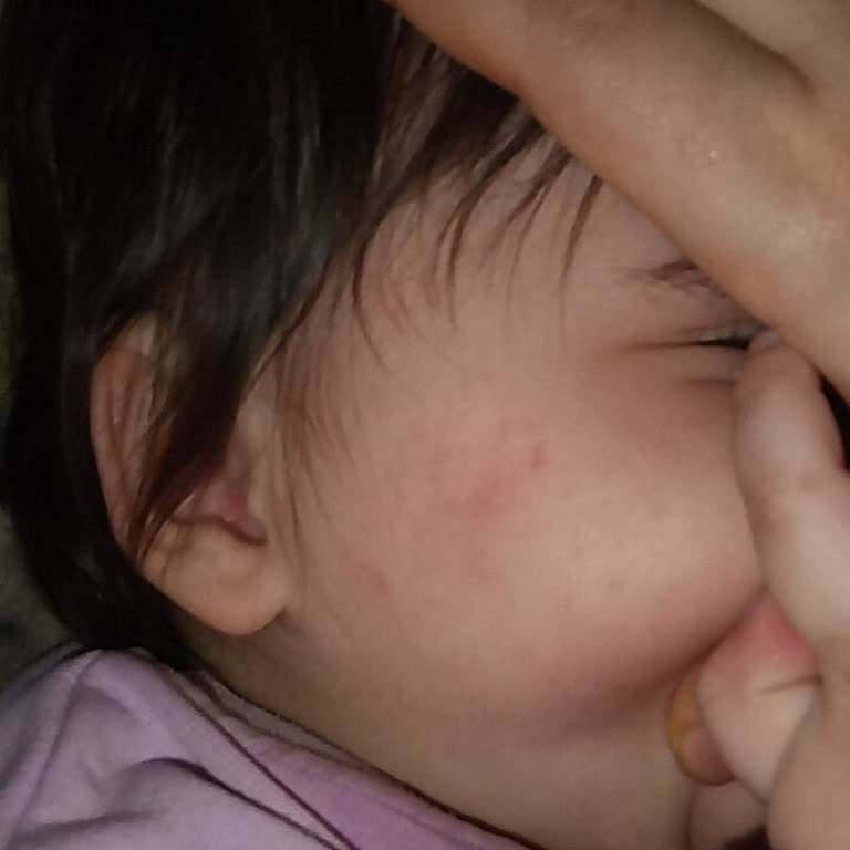 Chocolabs 1 Yaşındaki Çocuğumun Yüzündeki Isırık Ve Personelin Ciddiyetsiz Tutumu!