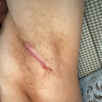 Innovation Beykent Güzellik Koltuk Altı Beyazlatma İşleminde Sağlık Sorunu!