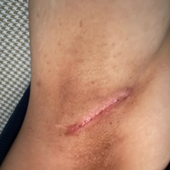 Innovation Beykent Güzellik Koltuk Altı Beyazlatma İşleminde Sağlık Sorunu!