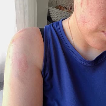 Korkmaz A156 Düdüklü Tencere Patlaması: Yanık Ve Ev Hasarı