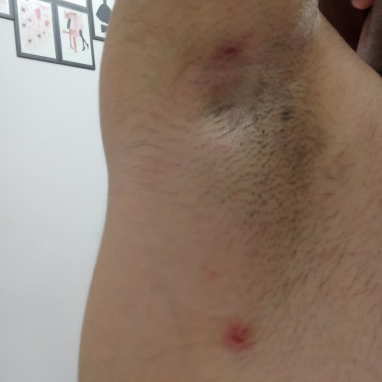 Axe Black Дезодорант Вызывает Раздражение Кожи