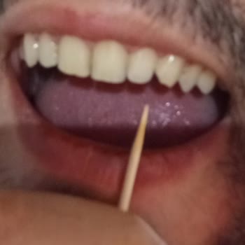 Çınaraltı Kebap Sert Cisim Nedeniyle Diş Kırılması