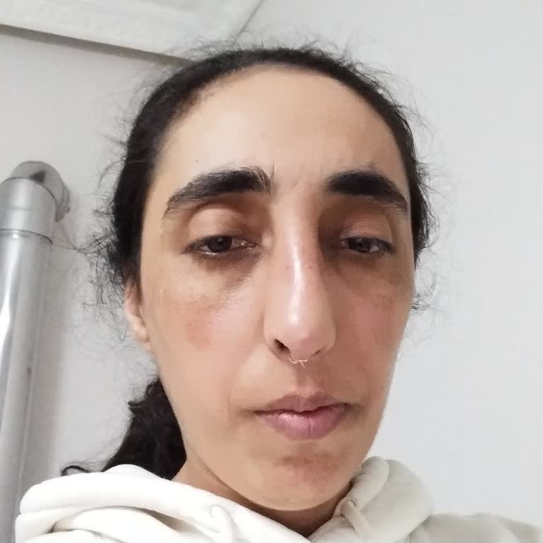 Rinoplasti Sonrası Estetik Ve Solunum Sorunları İçin Ücret İadesi Talebi