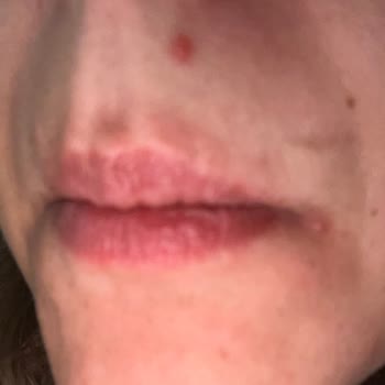 Procsin Hyaluronik Asit Kullanımından Şiddetli Sivilce Ve Ağrı Şikayeti