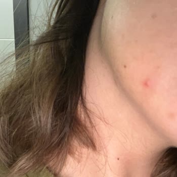 Procsin Hyaluronik Asit Kullanımından Şiddetli Sivilce Ve Ağrı Şikayeti