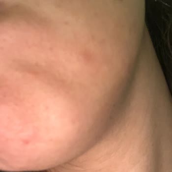 Procsin Hyaluronik Asit Kullanımından Şiddetli Sivilce Ve Ağrı Şikayeti