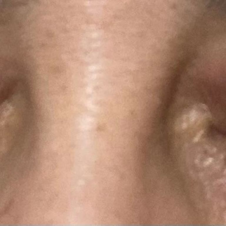 Contractubex Kullanımından Kaynaklanan Şiddetli Kaşıntı Ve Kızarıklık Nedeniyle 800 TL İade Talebi