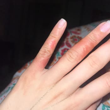 Stanley Termosunun Patlaması Nedeniyle Sağlık Ve İş Gücü Kaybı Tazminatı Talebi