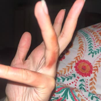 Stanley Termosunun Patlaması Nedeniyle Sağlık Ve İş Gücü Kaybı Tazminatı Talebi