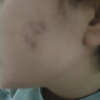 Yüzümde Oluşan Şiddetli Sivilceler Nedeniyle İade Ve Dermatoloji Masrafı Talebi