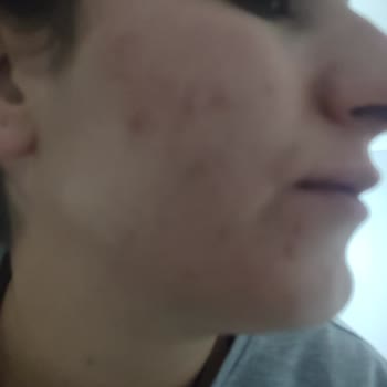 Yüzümde Oluşan Şiddetli Sivilceler Nedeniyle İade Ve Dermatoloji Masrafı Talebi