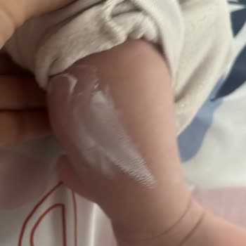 Isıya Dayanıklı Cam Tencere Gazlı Ocakta Patladı Ve Bebeğimiz Yanık Aldı