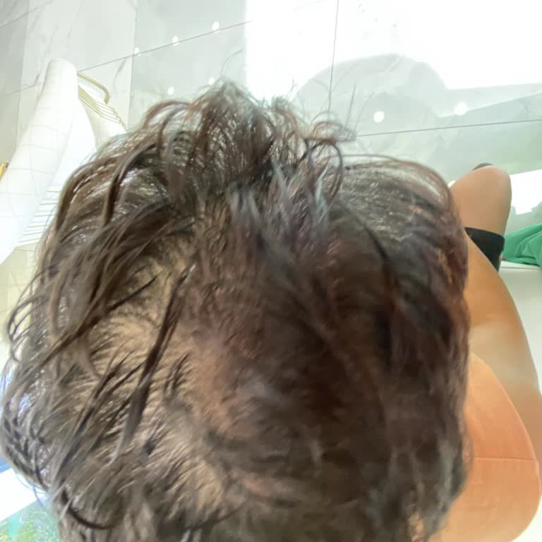 Saç Mezoterapisi %100 Sonuç Vaadi Yerine Getirilmedi Ve 10.000 TL İadesi Talebi