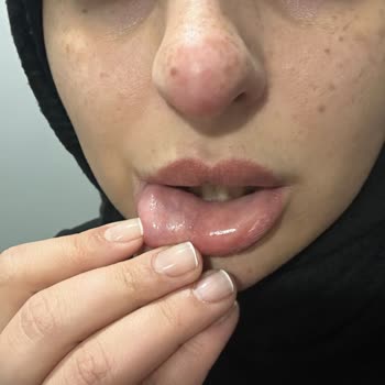 Nurlips Güzellik Yapılan Yanlış Uygulama Nedeniyle Ciddi Sağlık Ve Estetik Problemleri Yaşıyorum!