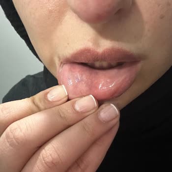 Nurlips Güzellik Yapılan Yanlış Uygulama Nedeniyle Ciddi Sağlık Ve Estetik Problemleri Yaşıyorum!