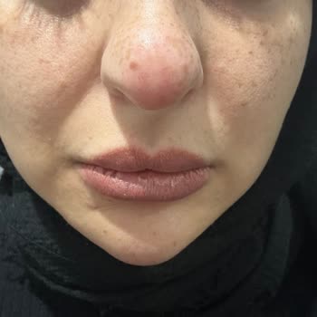 Nurlips Güzellik Yapılan Yanlış Uygulama Nedeniyle Ciddi Sağlık Ve Estetik Problemleri Yaşıyorum!