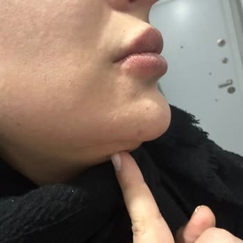 Nurlips Güzellik Yapılan Yanlış Uygulama Nedeniyle Ciddi Sağlık Ve Estetik Problemleri Yaşıyorum!