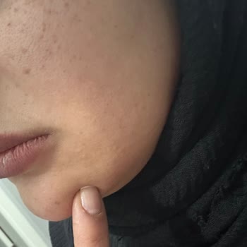 Nurlips Güzellik Yapılan Yanlış Uygulama Nedeniyle Ciddi Sağlık Ve Estetik Problemleri Yaşıyorum!