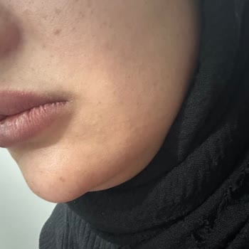 Nurlips Güzellik Yapılan Yanlış Uygulama Nedeniyle Ciddi Sağlık Ve Estetik Problemleri Yaşıyorum!