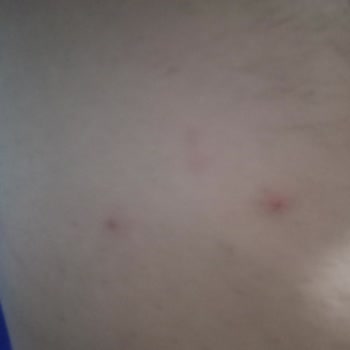 Apranax Ford İlacı Kullanımından Sonra Süregelen Kaşıntı Ve Ağrı Şikayetleri